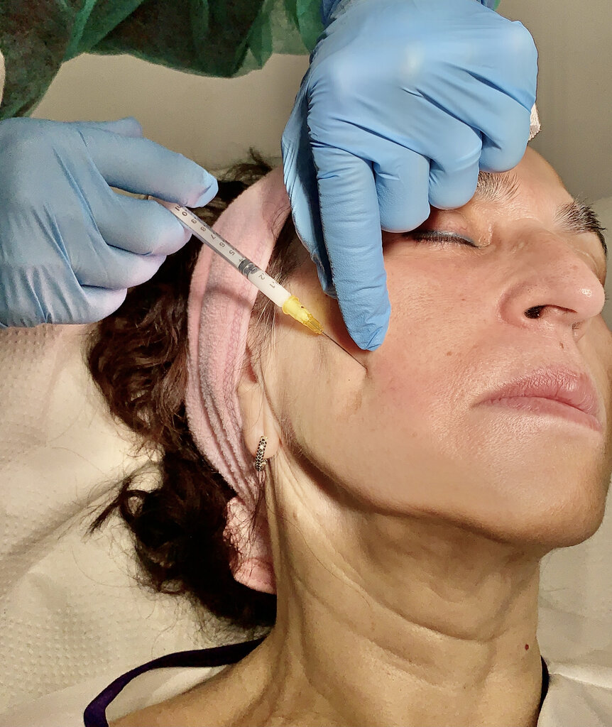 Aplicación de bioestimulador de colágeno en el rostro de una paciente para mejorar la firmeza y elasticidad de la piel.