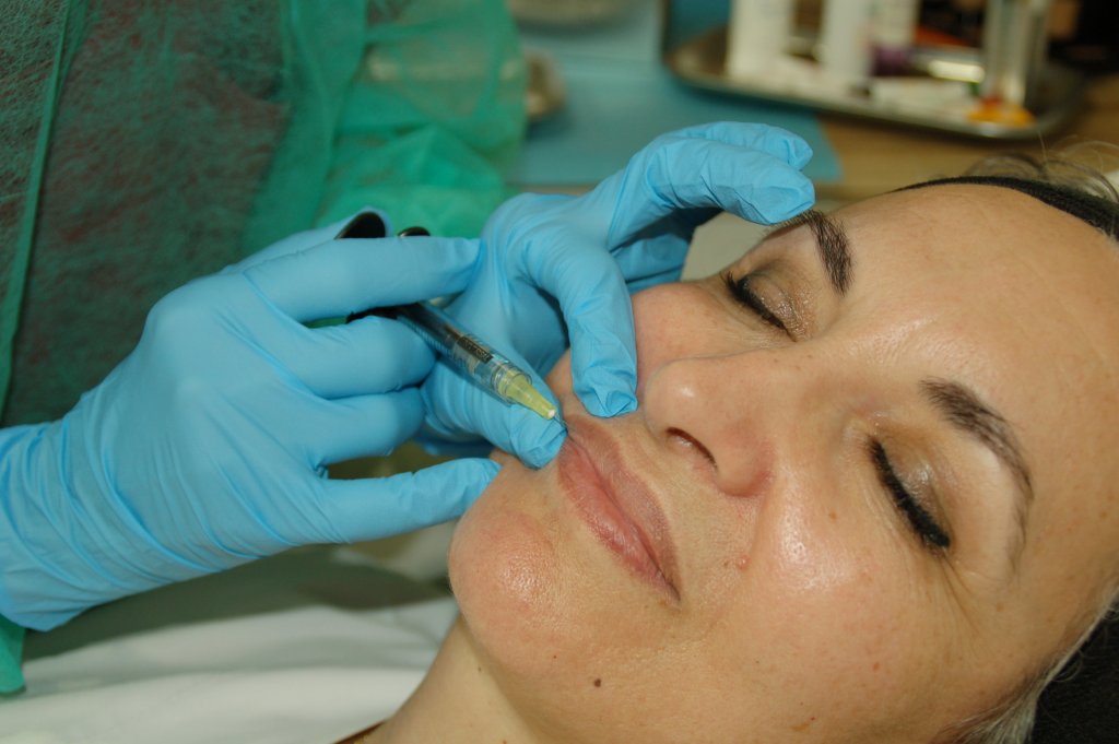 Aplicación de relleno con ácido hialurónico en el rostro de una paciente para hidratar y dar volumen.