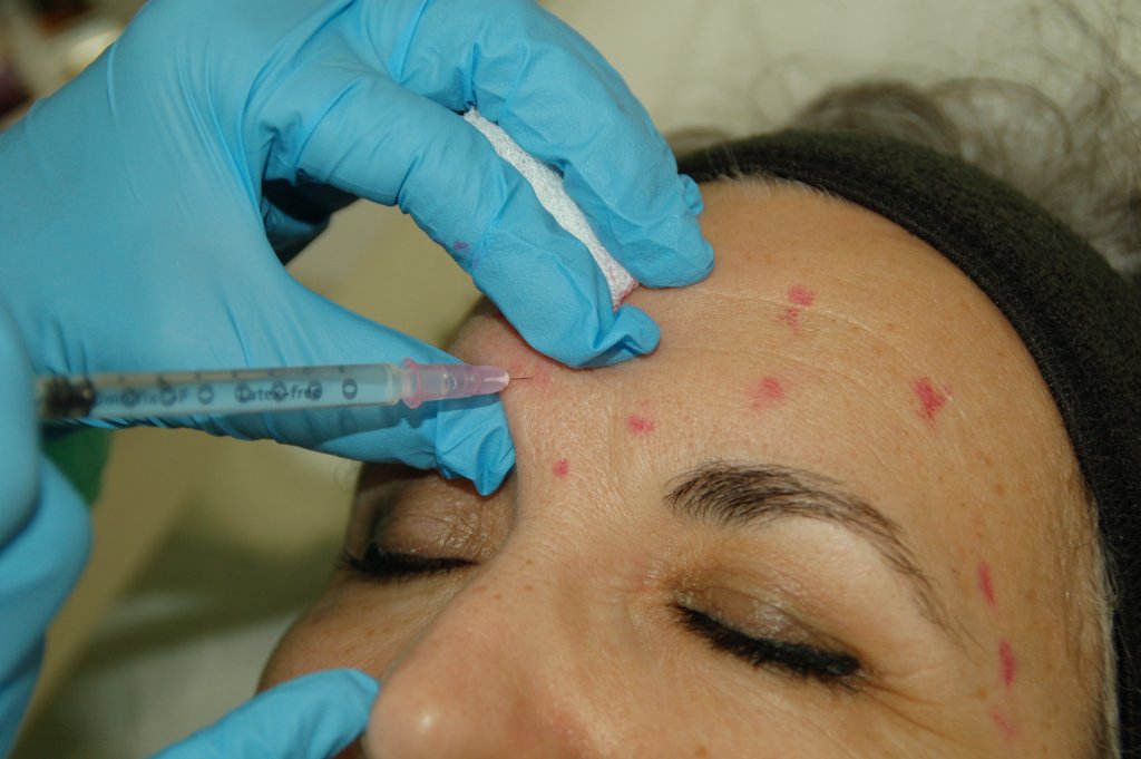 Aplicación de tratamiento con neuromoduladores en la frente de una paciente para reducir líneas de expresión.  title: