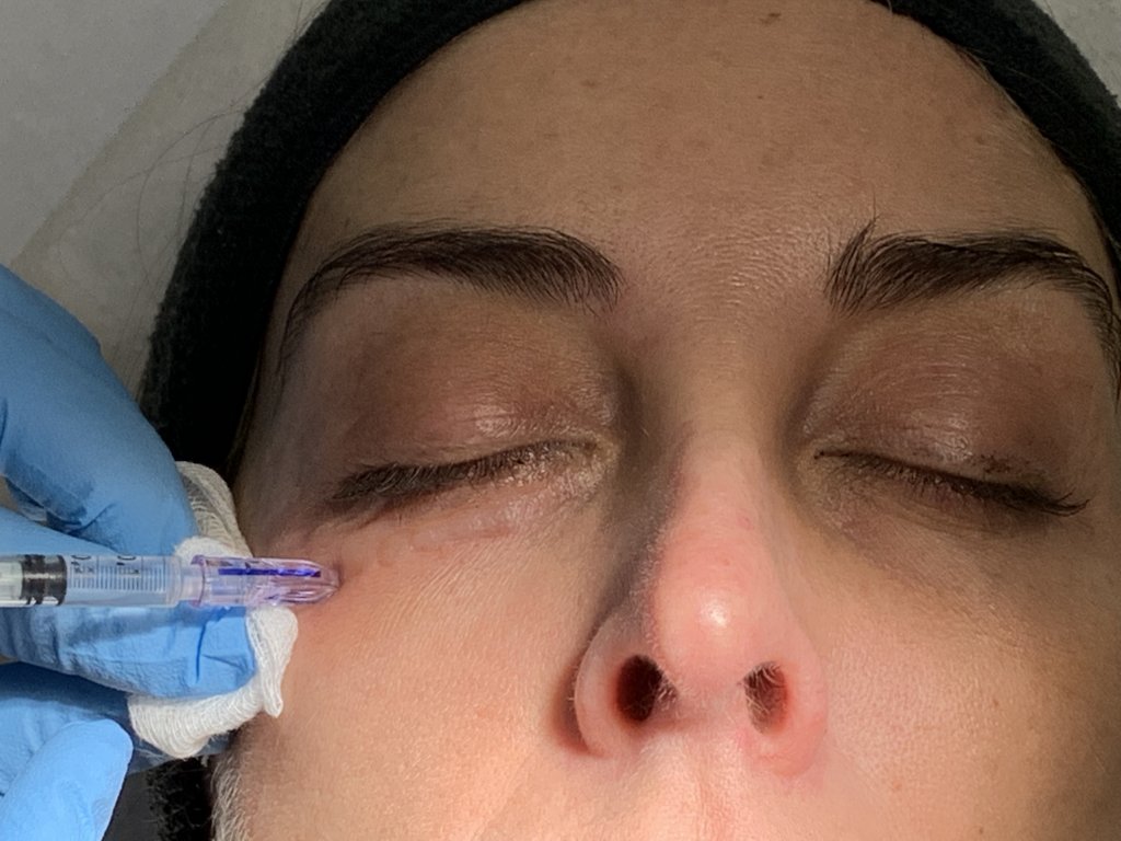 Aplicación de microinyecciones de mesoterapia facial en el contorno de ojos de una paciente.
